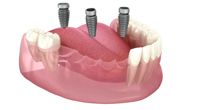 Recuperare I Stil De Via Cu Implanturi Dentare Ce Trebuie S Ti I