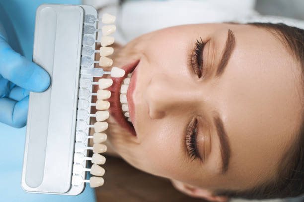 Ascunde imperfecțiunile: cum funcționează și când să alegi fațetele dentare